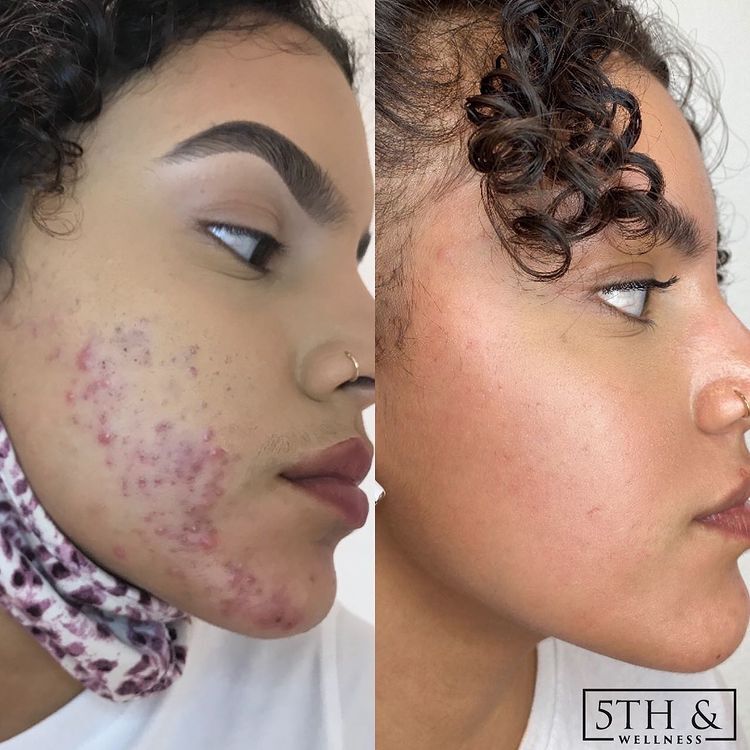 before and after results from SkinPen Microneedling Treatment