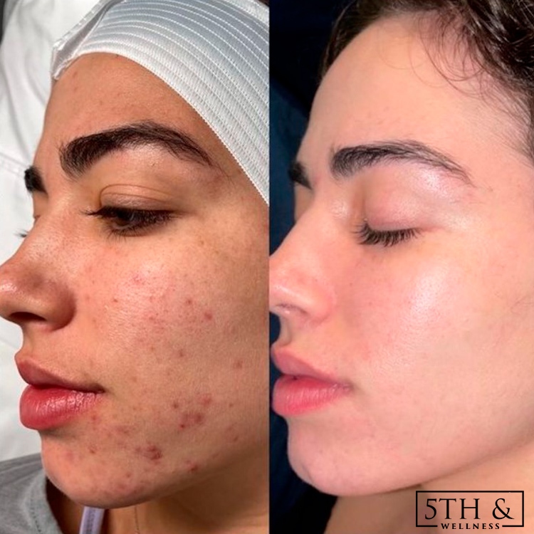 before and after results from SkinPen Microneedling Treatment