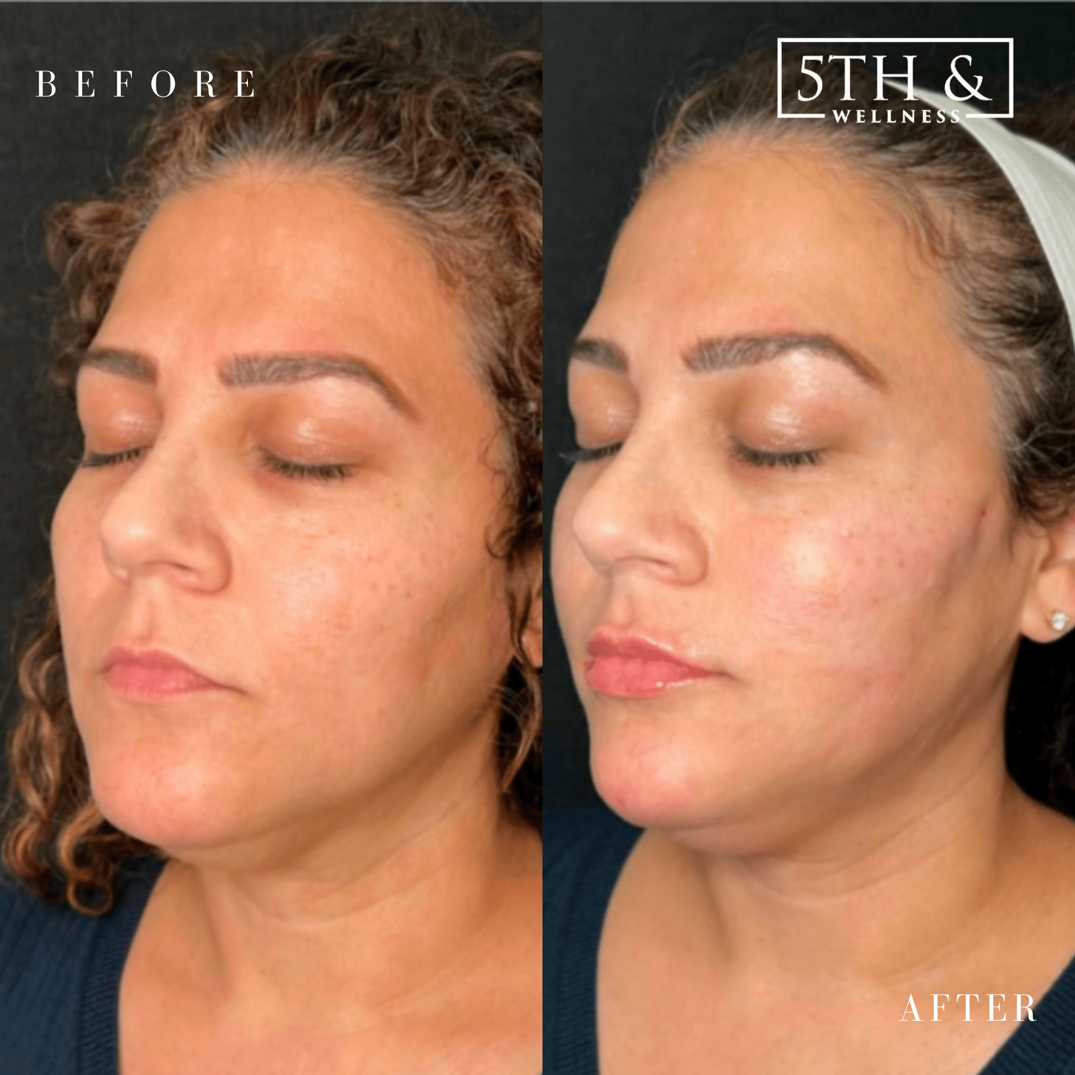 before and after results from 5th and Wellness treatment