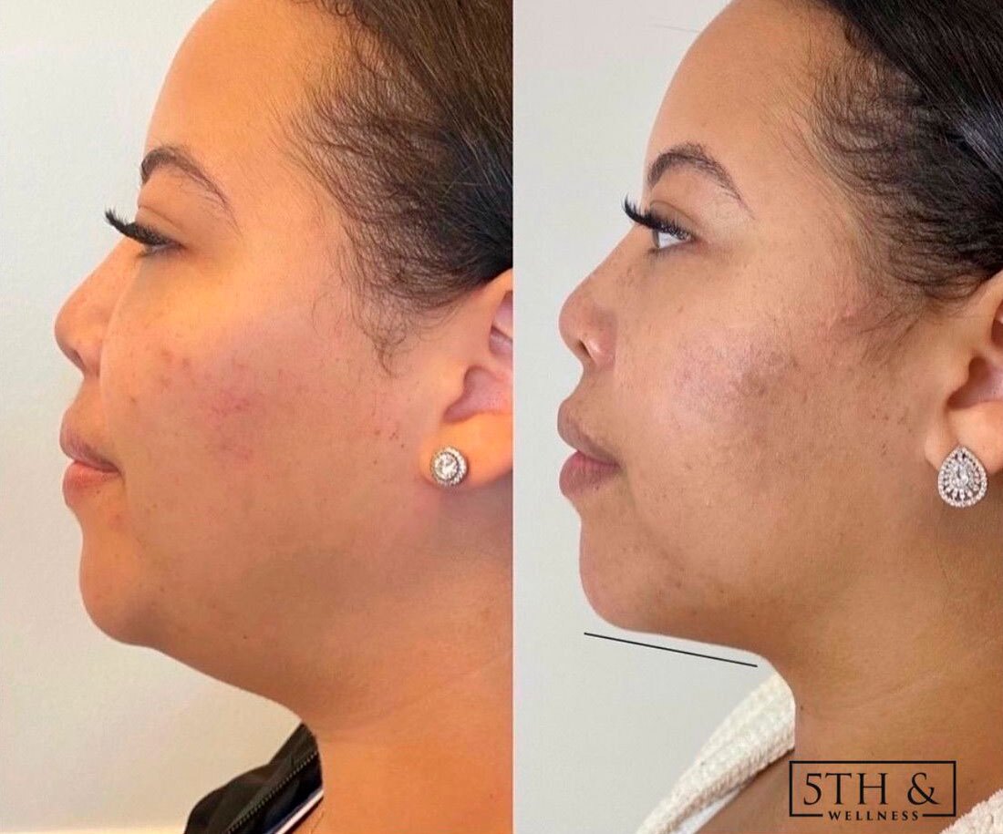 before and after results from Kybella treatment