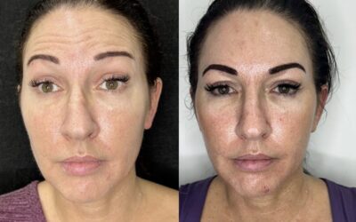 Botox Before and After Photo by 5th & Wellness in Boca Raton, FL