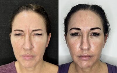 Botox Before and After Photo by 5th & Wellness in Boca Raton, FL