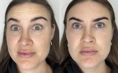 Botox Before and After Photo by 5th & Wellness in Boca Raton, FL