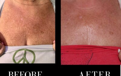 Chemical Peel Before and After Photo by 5th & Wellness in Boca Raton, FL