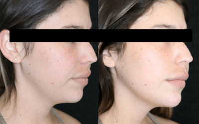 Fillers Before and After Photo by 5th & Wellness in Boca Raton, FL