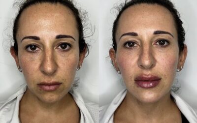 Fillers Before and After Photo by 5th & Wellness in Boca Raton, FL