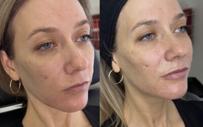 Fillers Before and After Photo by 5th & Wellness in Boca Raton, FL