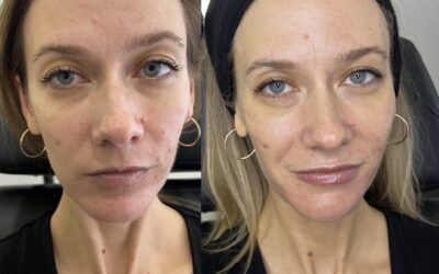 Fillers Before and After Photo by 5th & Wellness in Boca Raton, FL