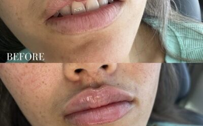 Fillers Before and After Photo by 5th & Wellness in Boca Raton, FL