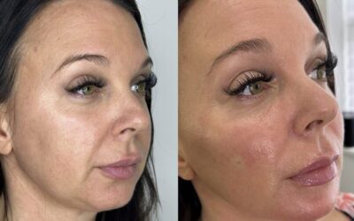 Fillers Before and After Photo by 5th & Wellness in Boca Raton, FL