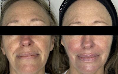 Fillers Before and After Photo by 5th & Wellness in Boca Raton, FL