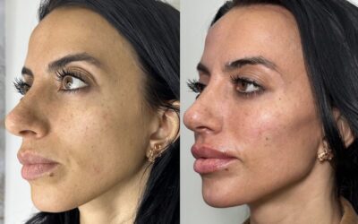 Fillers Before and After Photo by 5th & Wellness in Boca Raton, FL