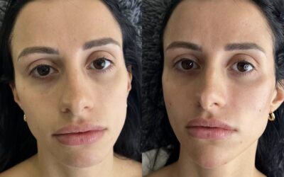 Fillers Before and After Photo by 5th & Wellness in Boca Raton, FL