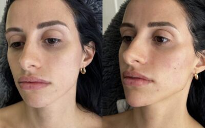 Fillers Before and After Photo by 5th & Wellness in Boca Raton, FL