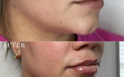 Fillers Before and After Photo by 5th & Wellness in Boca Raton, FL