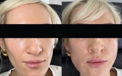 Fillers Before and After Photo by 5th & Wellness in Boca Raton, FL