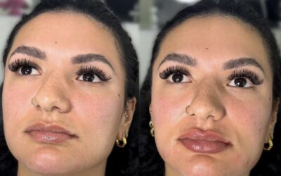 Fillers Before and After Photo by 5th & Wellness in Boca Raton, FL