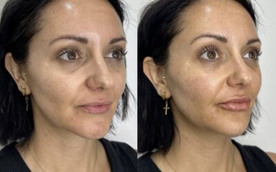 Fillers Before and After Photo by 5th & Wellness in Boca Raton, FL