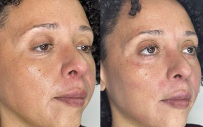 Fillers Before and After Photo by 5th & Wellness in Boca Raton, FL