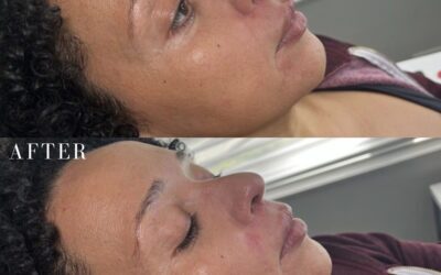 Fillers Before and After Photo by 5th & Wellness in Boca Raton, FL