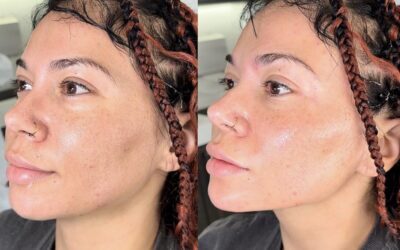 Fillers Before and After Photo by 5th & Wellness in Boca Raton, FL