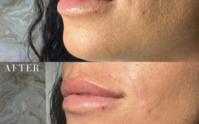 Fillers Before and After Photo by 5th & Wellness in Boca Raton, FL