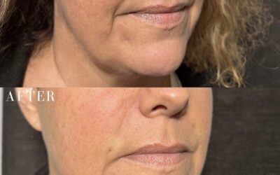 Fillers Before and After Photo by 5th & Wellness in Boca Raton, FL