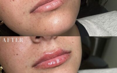 Fillers Before and After Photo by 5th & Wellness in Boca Raton, FL