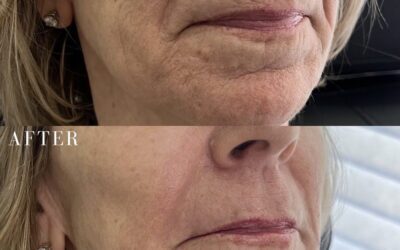 Fillers Before and After Photo by 5th & Wellness in Boca Raton, FL