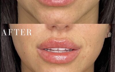 Fillers Before and After Photo by 5th & Wellness in Boca Raton, FL