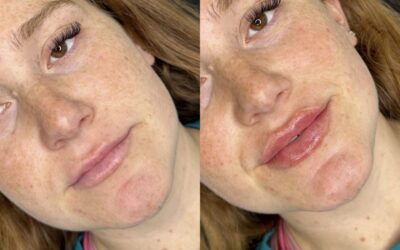 Fillers Before and After Photo by 5th & Wellness in Boca Raton, FL