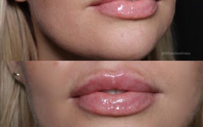 Fillers Before and After Photo by 5th & Wellness in Boca Raton, FL