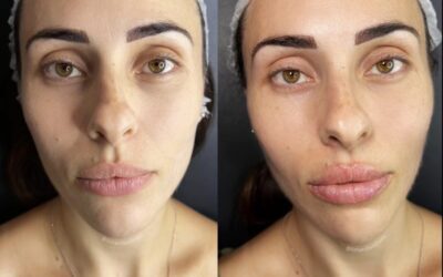 Fillers Before and After Photo by 5th & Wellness in Boca Raton, FL