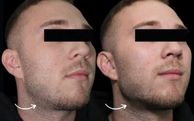 Fillers Before and After Photo by 5th & Wellness in Boca Raton, FL