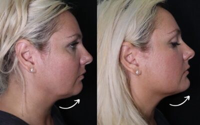 Fillers Before and After Photo by 5th & Wellness in Boca Raton, FL