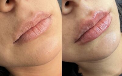 Fillers Before and After Photo by 5th & Wellness in Boca Raton, FL