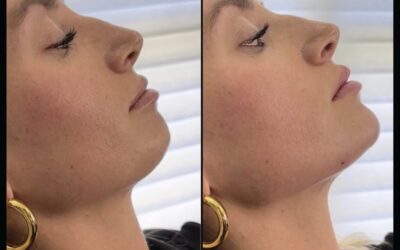 Fillers Before and After Photo by 5th & Wellness in Boca Raton, FL