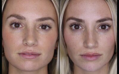 Fillers Before and After Photo by 5th & Wellness in Boca Raton, FL