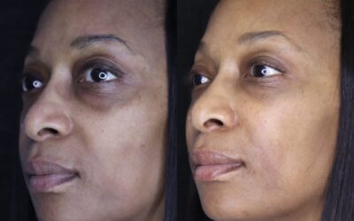 Fillers Before and After Photo by 5th & Wellness in Boca Raton, FL