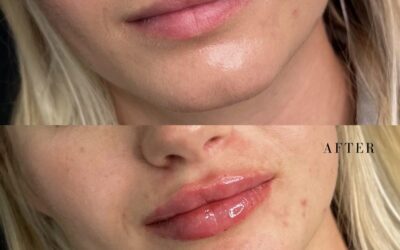 Fillers Before and After Photo by 5th & Wellness in Boca Raton, FL