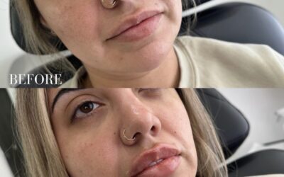 Fillers Before and After Photo by 5th & Wellness in Boca Raton, FL