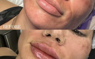 Fillers Before and After Photo by 5th & Wellness in Boca Raton, FL