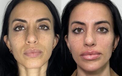 Fillers Before and After Photo by 5th & Wellness in Boca Raton, FL