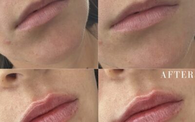 Fillers Before and After Photo by 5th & Wellness in Boca Raton, FL