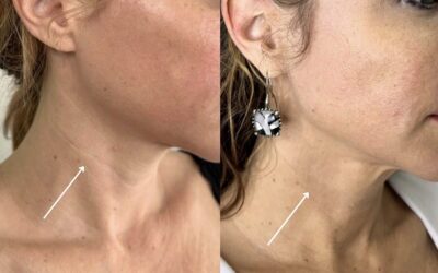 Fillers Before and After Photo by 5th & Wellness in Boca Raton, FL