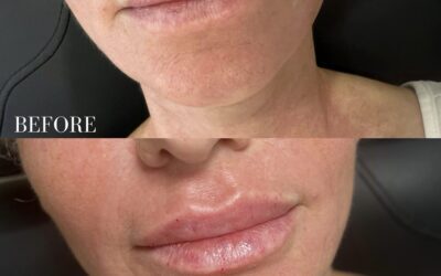 Fillers Before and After Photo by 5th & Wellness in Boca Raton, FL