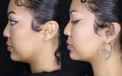 Kybella Before and After Photo by 5th & Wellness in Boca Raton, FL