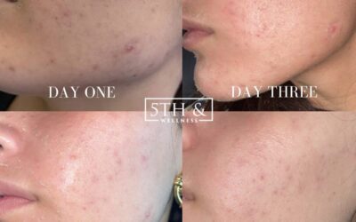 before and after results from Chemical Peel treatment at 5th and Wellness in Boca Raton, FL