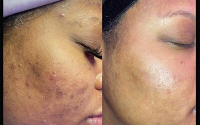 before and after results from Chemical Peel treatment at 5th and Wellness in Boca Raton, FL