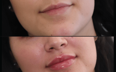 before and after results from filler treatment at 5th and Wellness in Boca Raton, FL